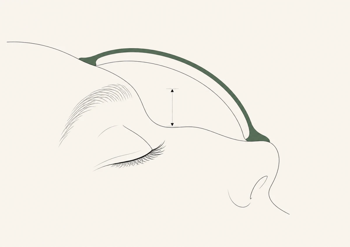 Coupe latérale du même visage avec Olesik : la voûte moulée prend appui sur l’os frontal et la pommette, et laisse 12 mm de vide au-dessus de la paupière et des cils.